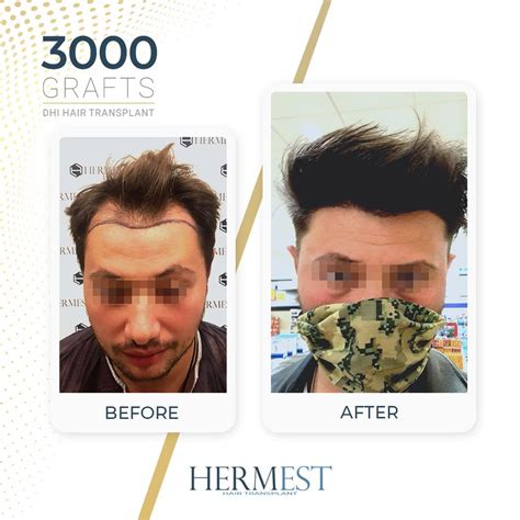 hermest hair transplant clinic.